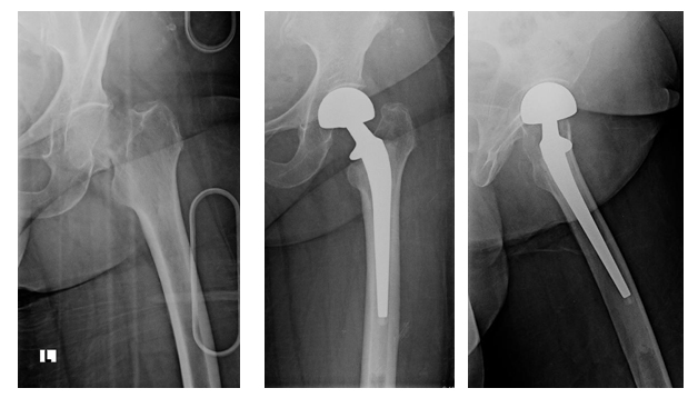 82 yaşında kadın hastamızın evde düşme sonucu kalça kemiği boynunda ayrılmış kırık oluştu.  Kaynama potansiyeli düşük tipte olan bu kırık için protez  ameliyatı yapıldı. Solda hastamızın ameliyat öncesi ön-arka  grafisi, sağda protez ameliyatından sonraki ön-arka ve yan grafileri görülmekte.  