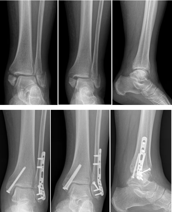 Ayak bileği dış ve iç malleol kırığı olan 75 yaşındaki kadın hastamızın dış malleolüne plak-vida, iç malleolüne ise kanüllü vida ile sabitleme yapıldı. 
