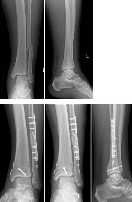 Ayak bileği dış malleol yukarı seviye kırığı, arka malleol kırığı, deltoid bağ ve sindesmoz yırtığı olan 27 yaşındaki erkek sporcu hastamızın dış malleolüne plak-vida, arka malleolüne kanüllü vida, deltoid bağına ancor, sindesmoza ise 2 adet Tight-Rope ile sabitleme yapıldı. 